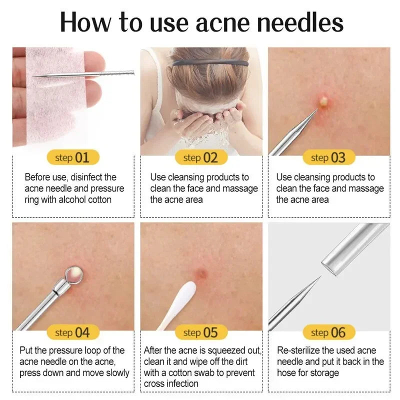 11-Piece Blackhead & Blemish Removal Tool Set - Acne Extractor Kit for Clear, Smooth Skin